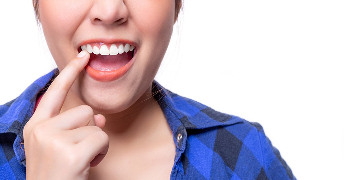 Dental crowns at Northridge Dental Group in Northridge, CA
