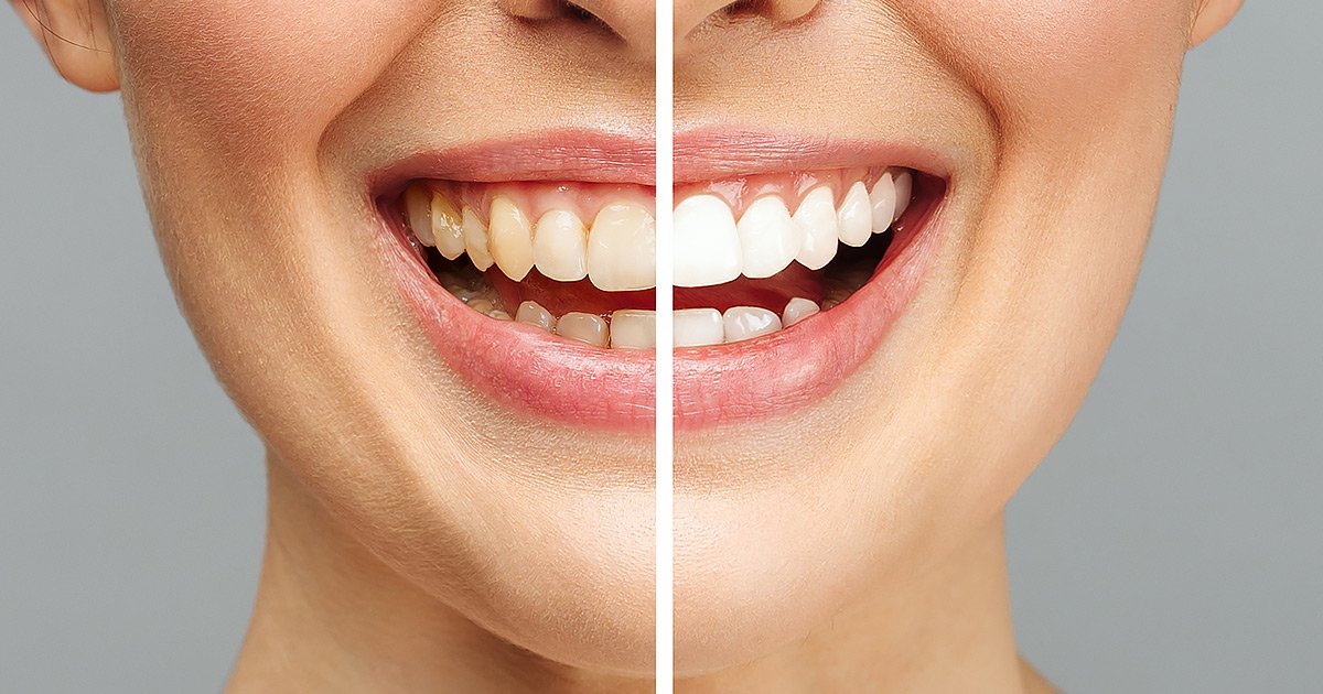 Teeth whitening at Northridge Dental Group