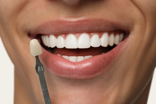 Porcelain Veneers Porcelain Veneers