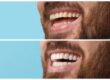 teeth whitening northridge