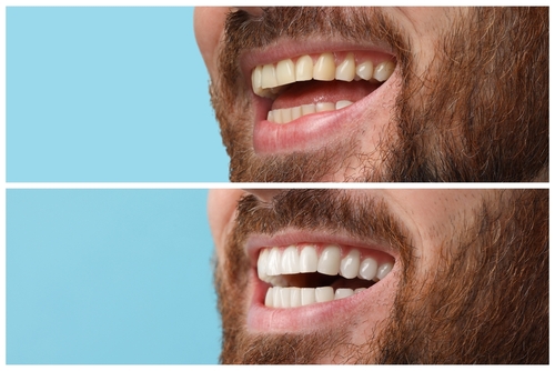 Teeth Whitening Northridge teeth whitening northridge