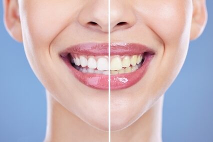 can yellow teeth become white